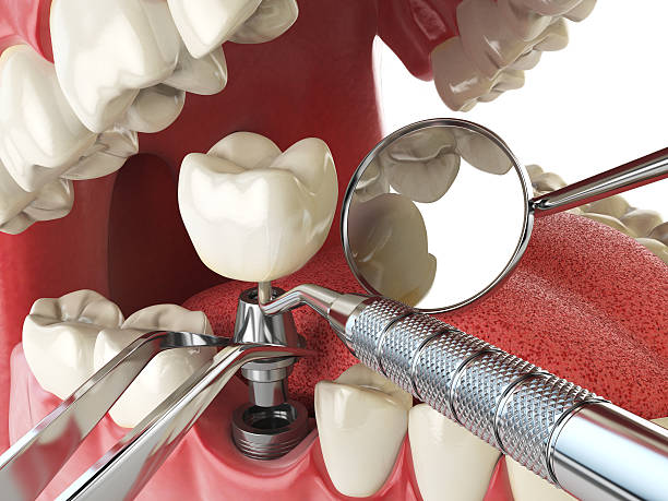 Best Emergency Treatment for Dental Infections or Abscesses in West Haverstraw, NY